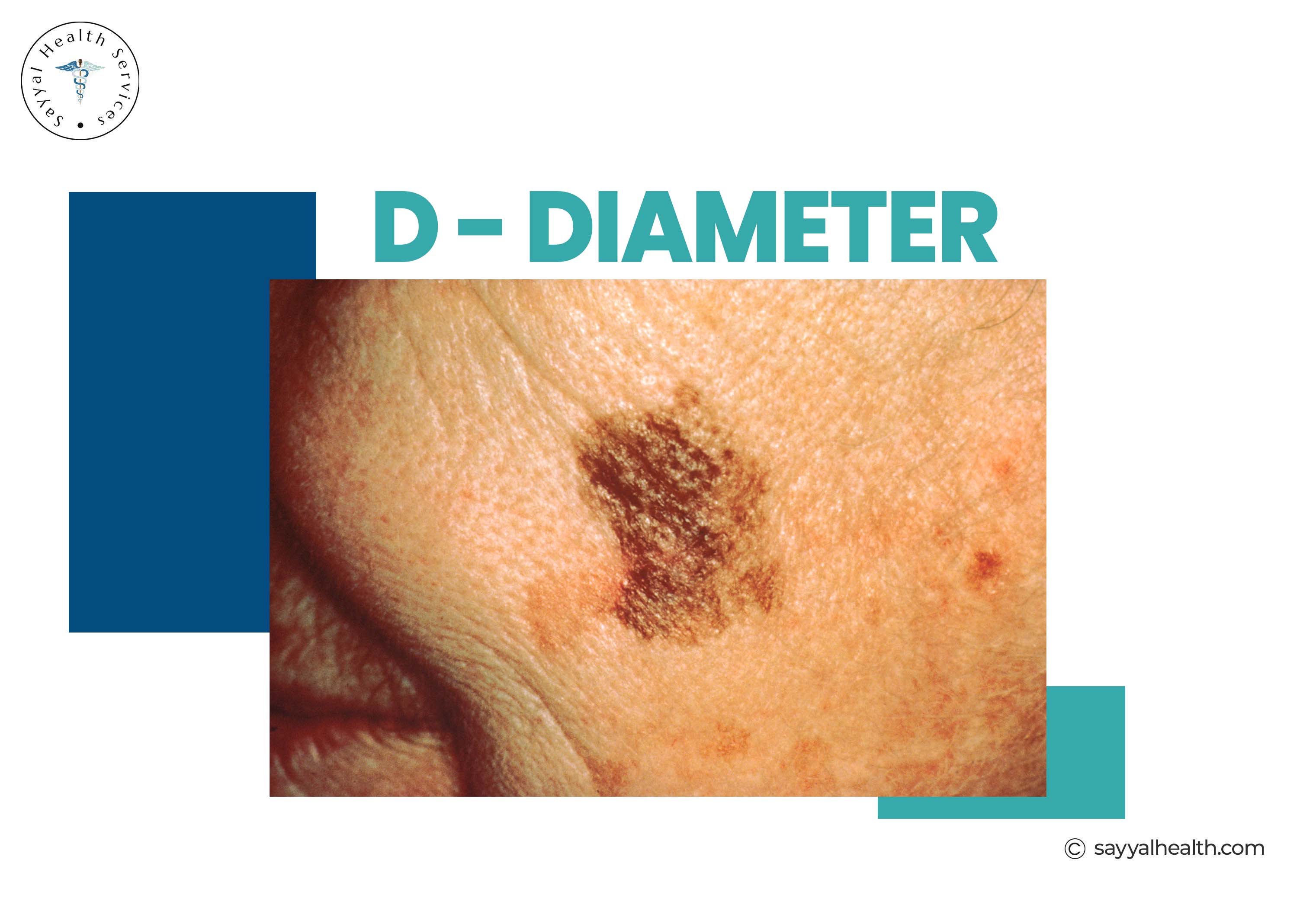 Melanoma diameter - skin lesion larger than 6mm